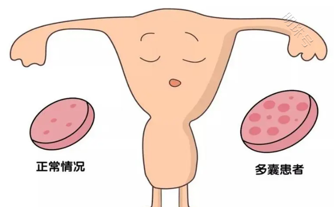 多囊卵巢综合征减肥成功后，就能自愈了吗？