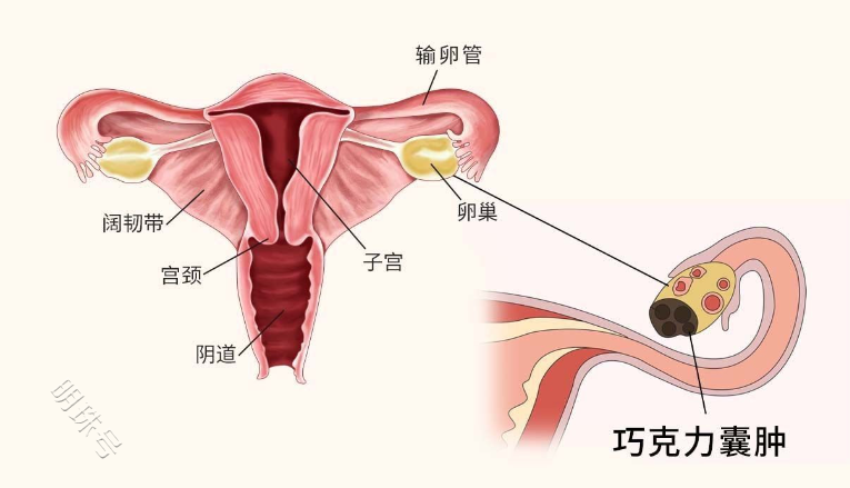 巧克力囊肿跟吃巧克力有关吗？它是怎么影响怀孕的？