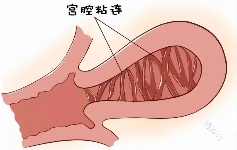 宫腔镜分粘后为什么会复粘？一些常见疑问看这里