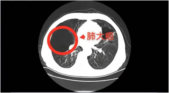 成都中医哮喘医院：妙手上演肺大疱消失术 帮助肺大泡患者实现呼吸自由