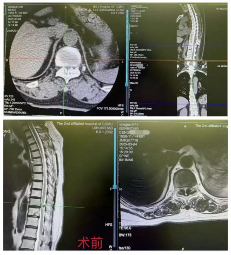 宽仁·特色技术⑥｜“单孔”微创突破“脊柱外科禁区”，胸椎管狭窄患者术后三天下床走路！