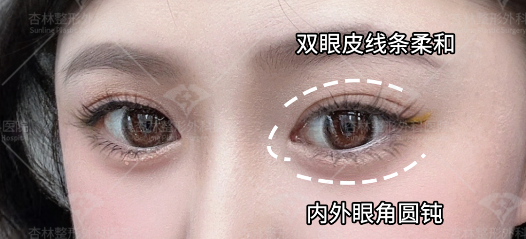 杏林整形：如何获得妈生双眼皮？