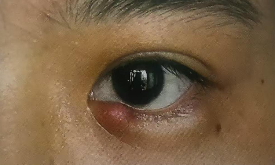 眼睑上的小包竟是它！医生教你这样远离“霰粒肿”困扰