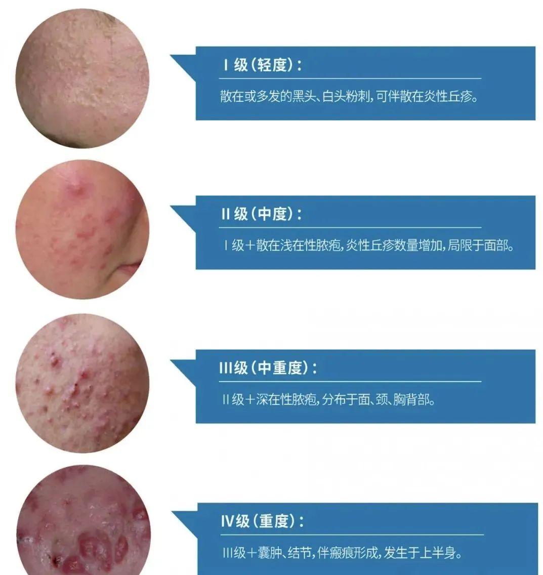 青岛西海岸第二医院暑期痤疮治疗半价，预约从速