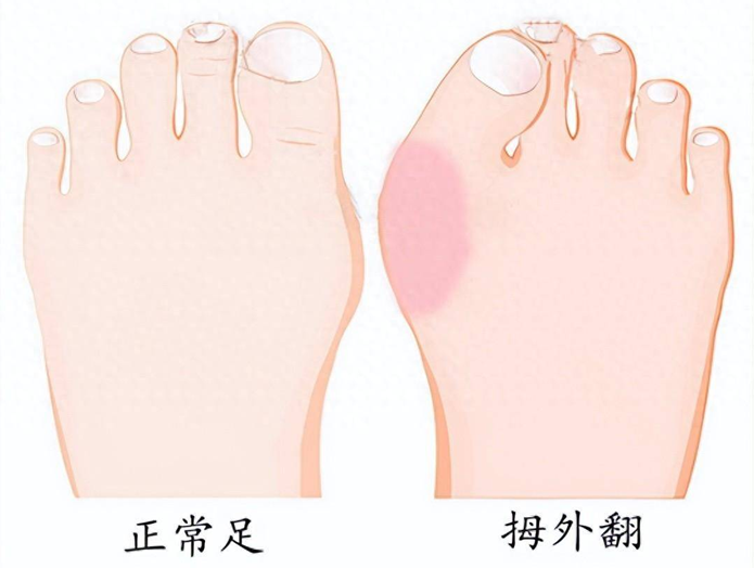什么程度的拇外翻（大脚骨）需要矫正？关节外科专家详解