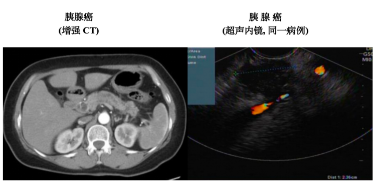 超声内镜（EUS）：胰腺癌诊断的关键利器