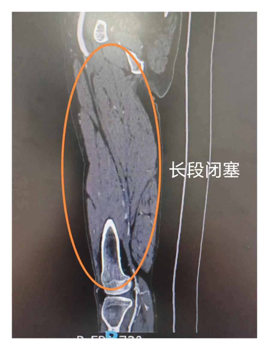 跨越千里迈向新生，内蒙古患者在滨州市人民医院重获行走自由