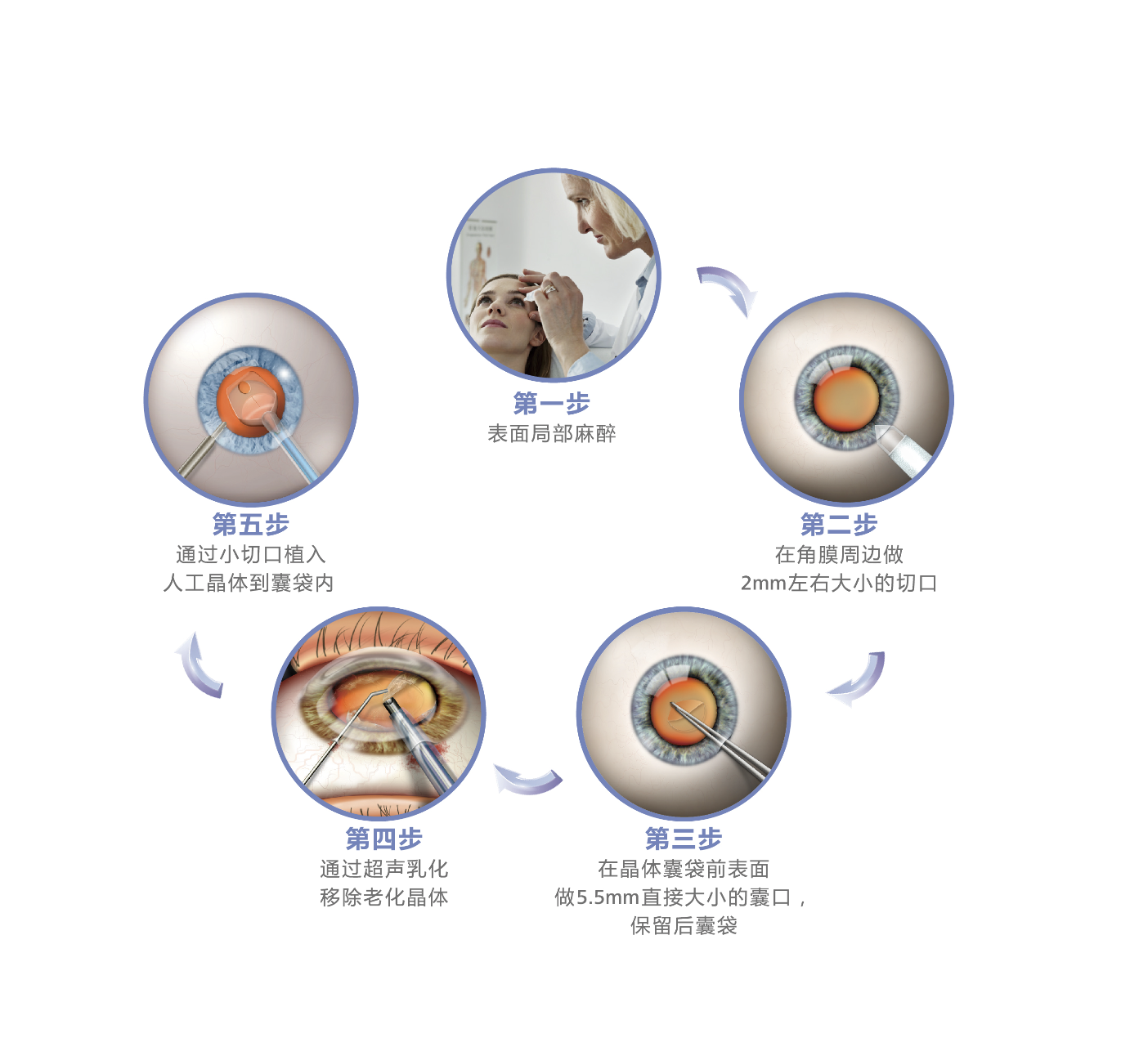 蔡司发明全球首个三焦点晶体 十年长效稳定脱镜率超90%