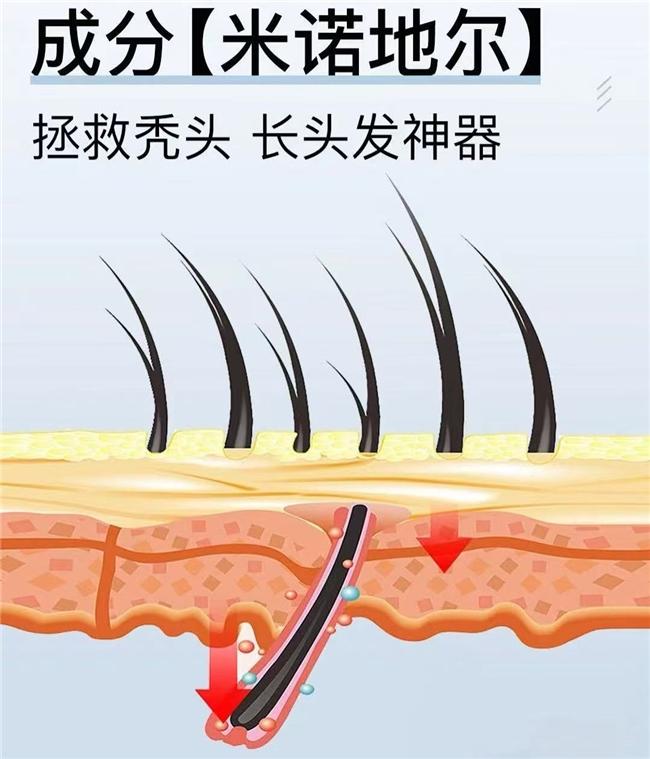 脱发怎么办？从米诺地尔酊到泡沫剂 蔓迪5%黄金浓度满足全方位需求