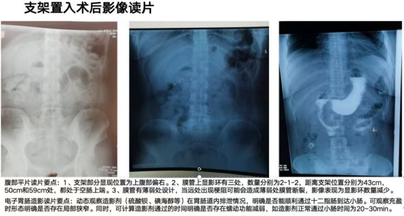 告别减重困境！济南南郊医院消化内科胃转流支架助你科学减重