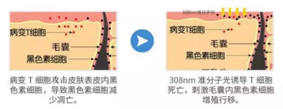 为何选进口308nm准分子激光？有效控制白癜风患者白斑扩散