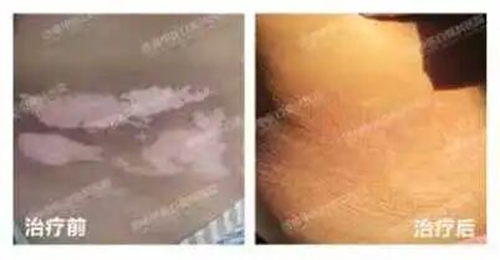 为什么治疗效果不好？许多患者还在犯！进来看白癜风专家怎么说