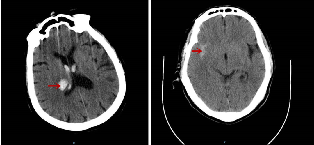 急诊科同时收治两位脑出血患者！烟台山医院专家：“多事之秋”更需管理好情绪