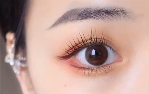 厦门美莱双眼皮|双眼皮手术埋线还是全切更好？ 恢复期要多久才能自然？