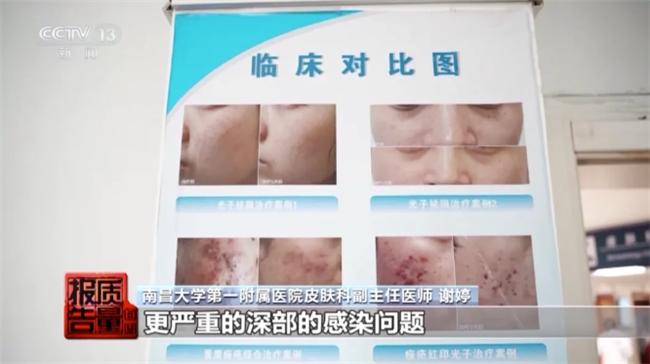 “针清”后痘痘不减反增 这些祛痘方法操作不当可能会“烂脸”