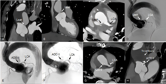 黄连军教授团队在主动脉外科术后吻合口漏介入治疗领域取得重要进展