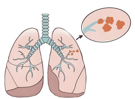 秋冬养肺正当时！济南南郊医院王言森教授提醒：肺结节人群需关注这些信号
