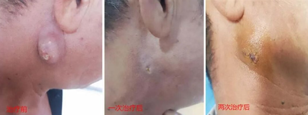 警惕！体表脓肿破溃？元凶竟是它！