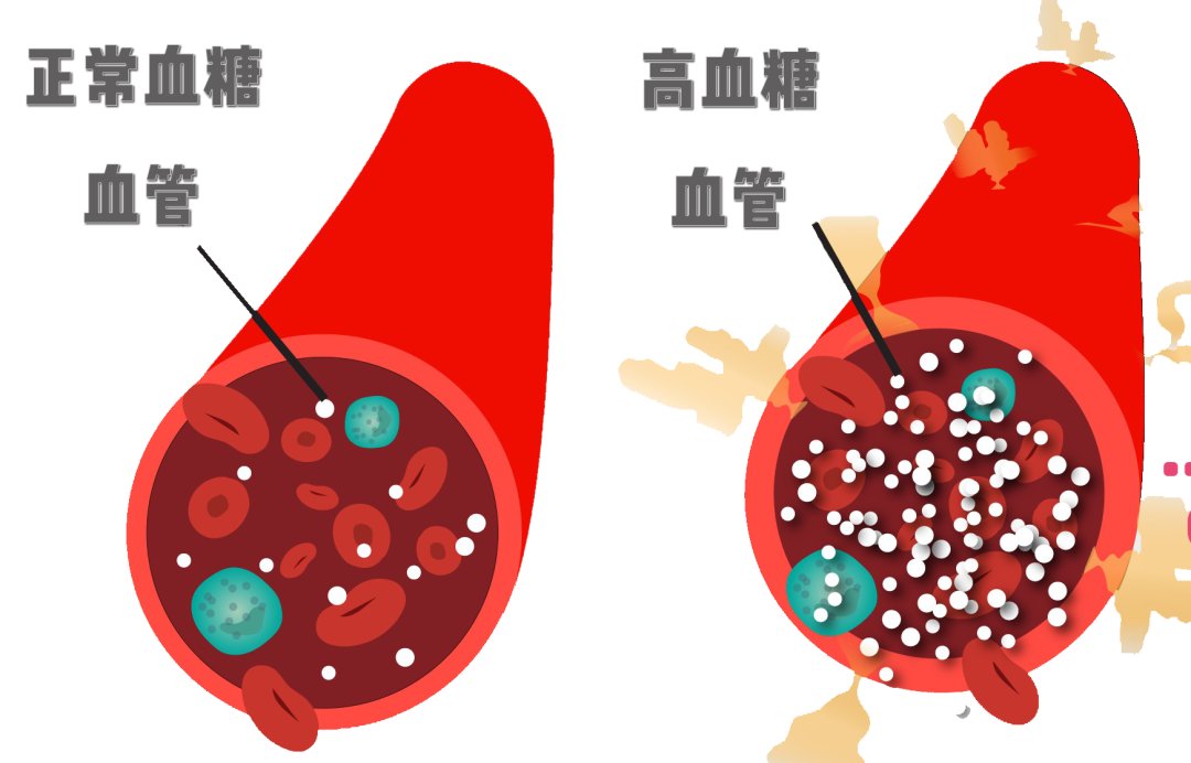 尖峰眼科解答：年轻人得了糖尿病性白内障怎么办？